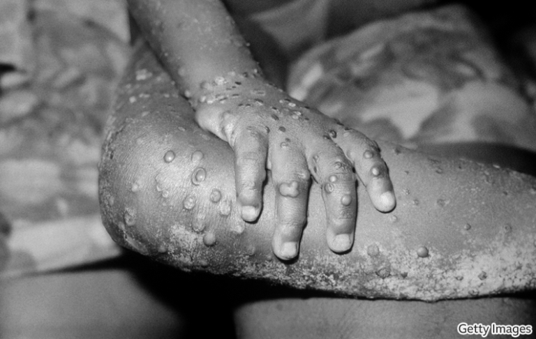 A New Case Of Monkeypox Was Reported In Three Other Continents, A First For This Disease.