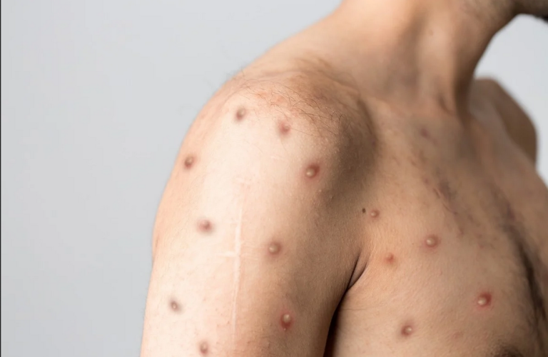 The Male With The California Monkeypox Virus Urges Others To Receive Vaccinated.