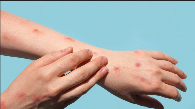 If You’ve Been Worried About Monkeypox, Our Medical Analyst Has Answers For You.